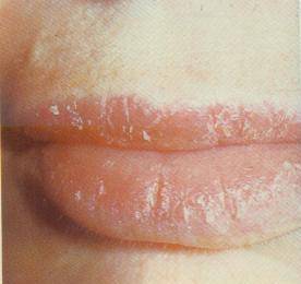Губы трескаются и шелушатся — причины и лечение, что делать в первую очередь