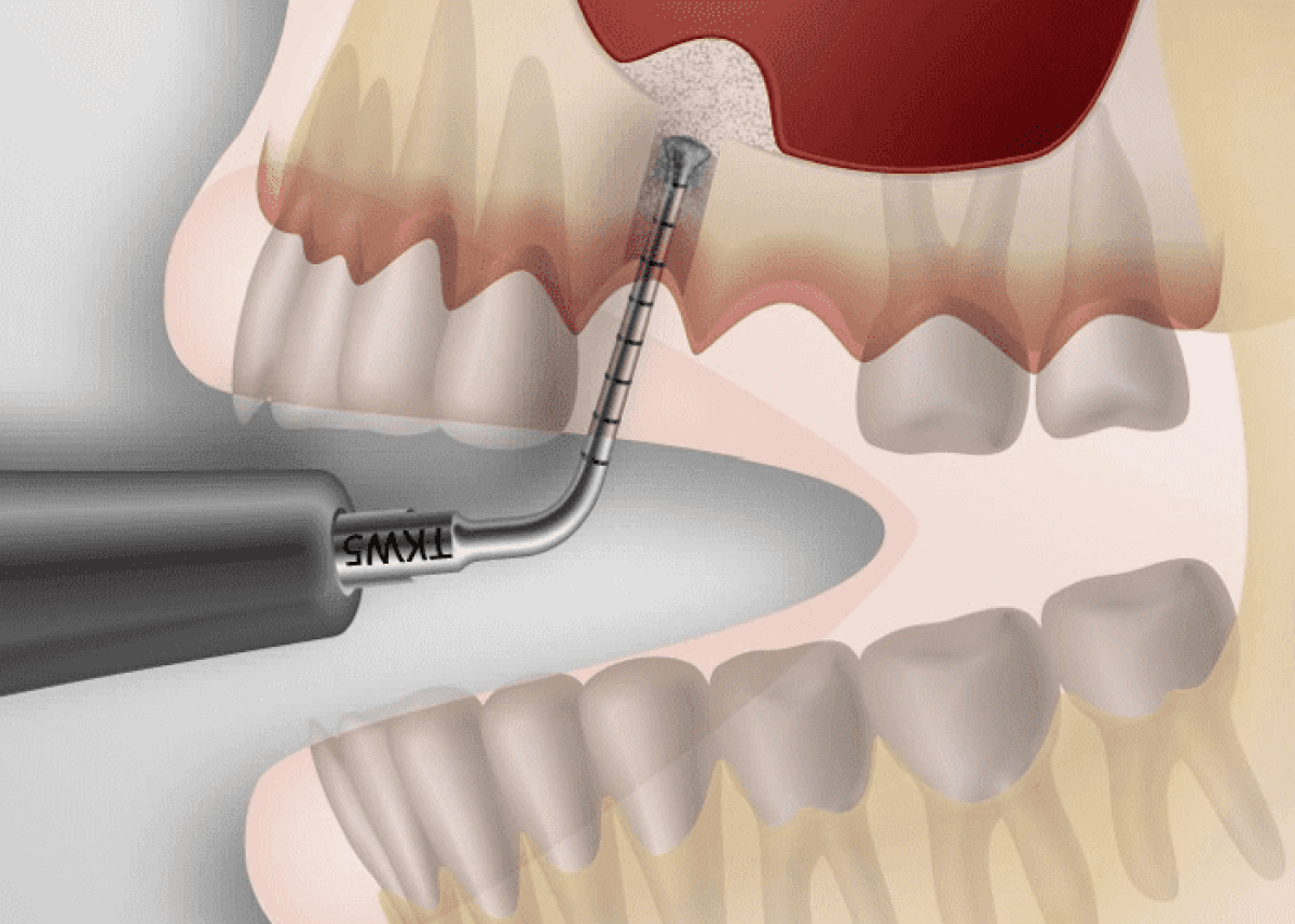 Синус-лифтинг при имплантации зубов. наращивание кости на верхней челюсти