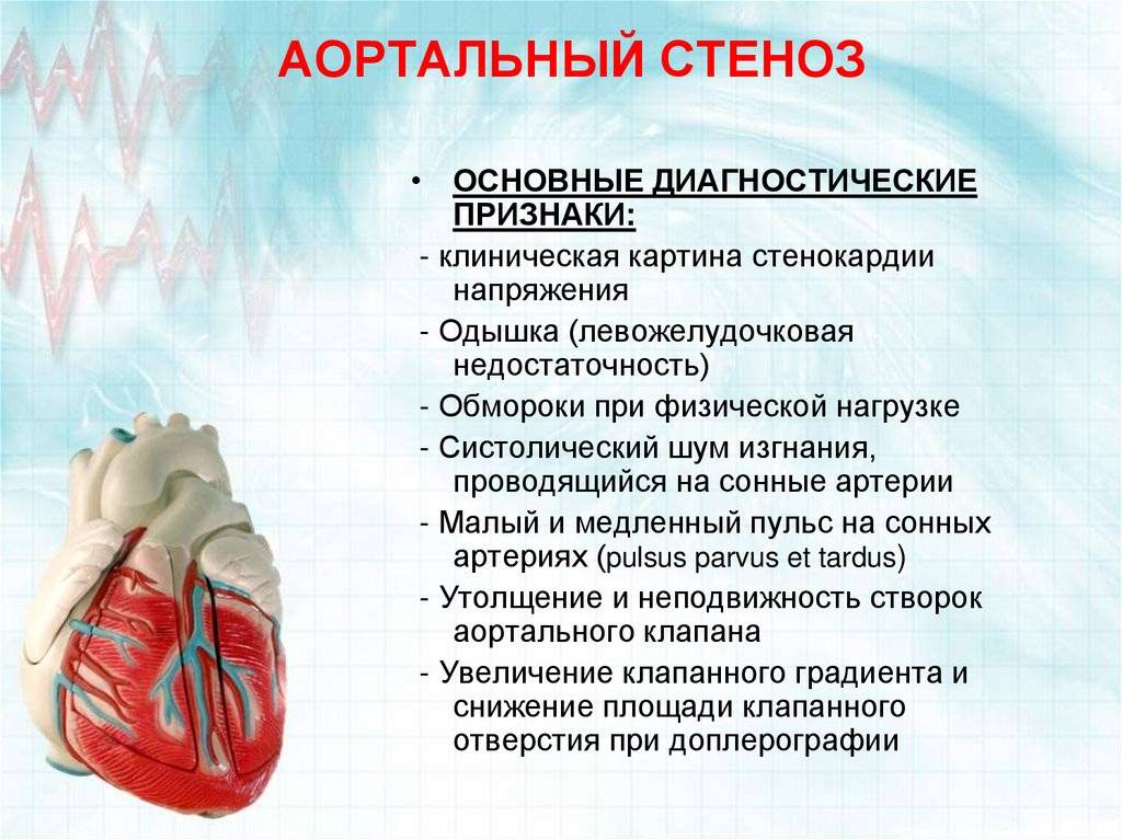 Аортальный стеноз сердца: патофизиология, причины, признаки, симптомы | кардио болезни