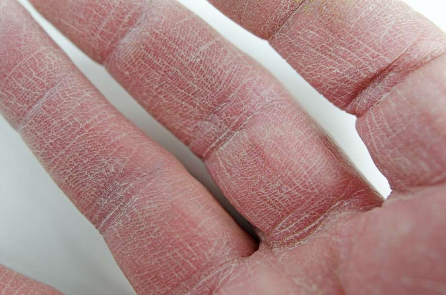 Сохнет и трескается кожа на руках: фото, заболевания, лечение | заболевания кожи