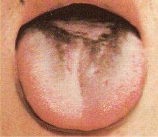 Коричневый налет на языке у ребенка: причины почему он может появиться, диагностика и лечение