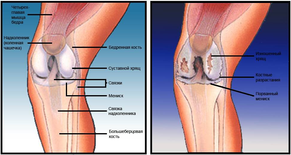 Артроз коленного сустава боль с внутренней стороны