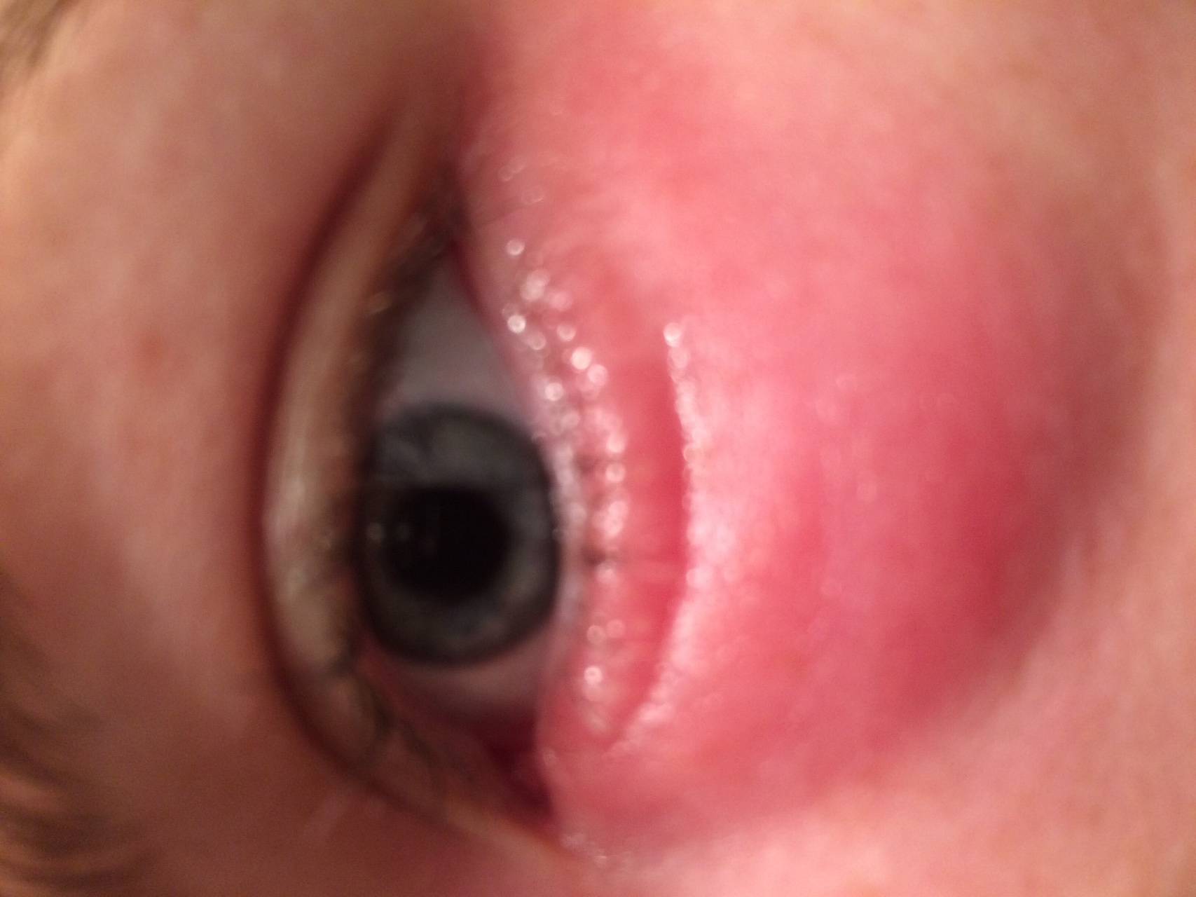 Аллергическое покраснение глаз