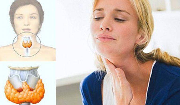 Как лечат щитовидку у женщин | pro shchitovidku