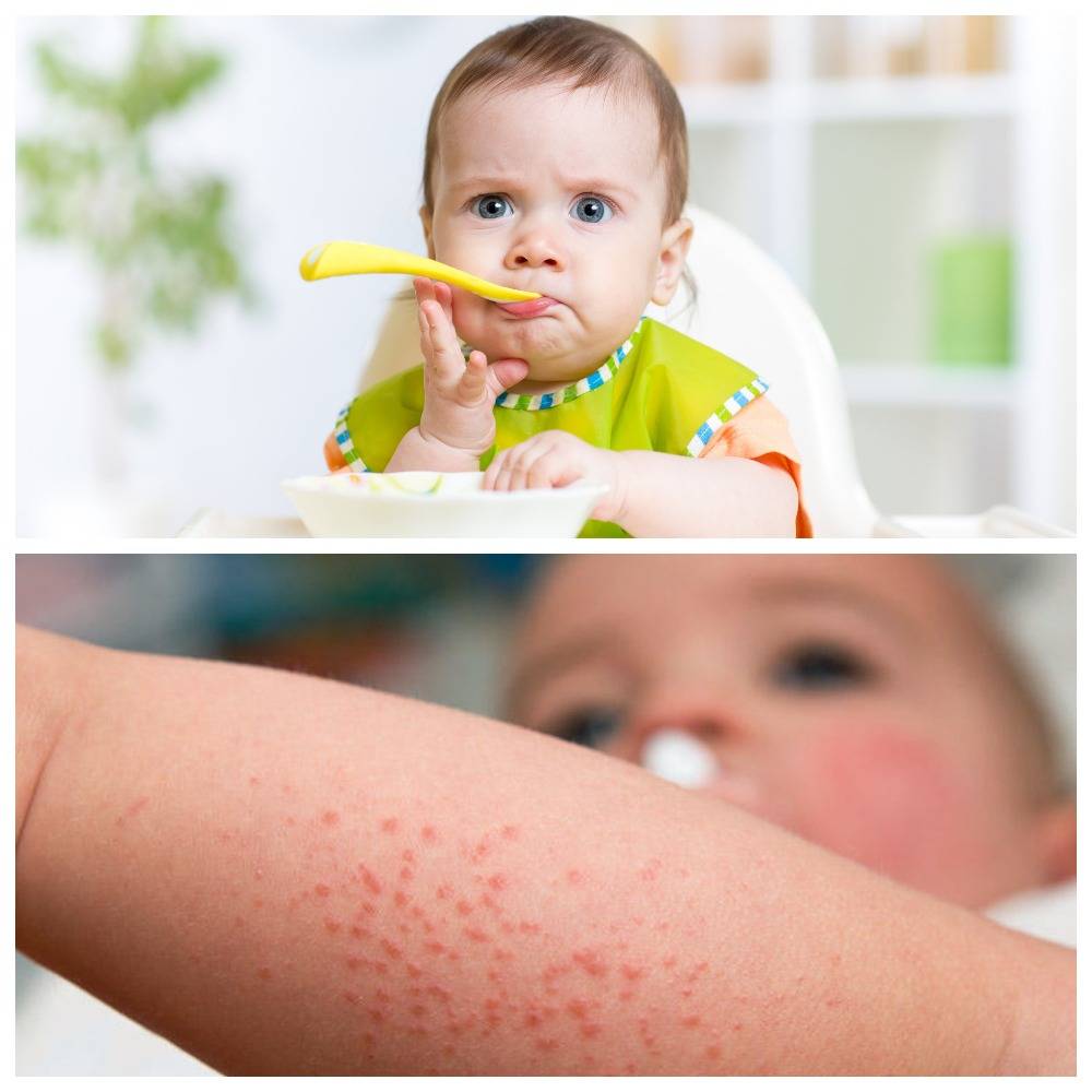 Аллергия на глютен: симптомы у ребенка и взрослого
