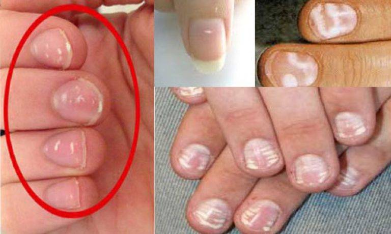 Белые пятна на ногтях у ребенка и взрослого: причины | компетентно о здоровье на ilive