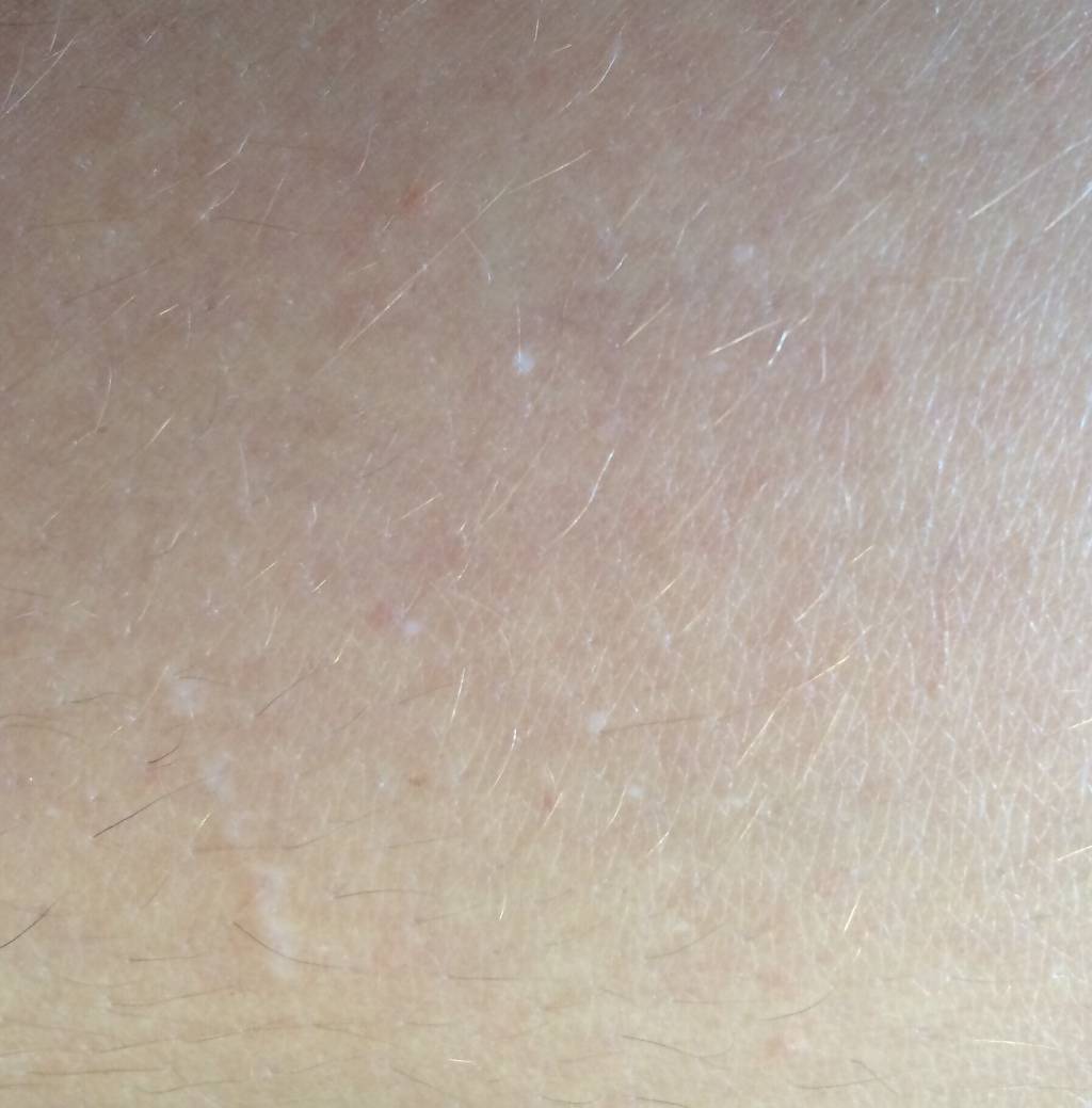 Появление белых пятен на коже: что это такое, как лечить светлые точки на спине и теле, фото