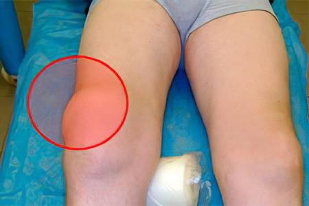 Анзериновый бурсит коленного сустава: симптомы, лечение...