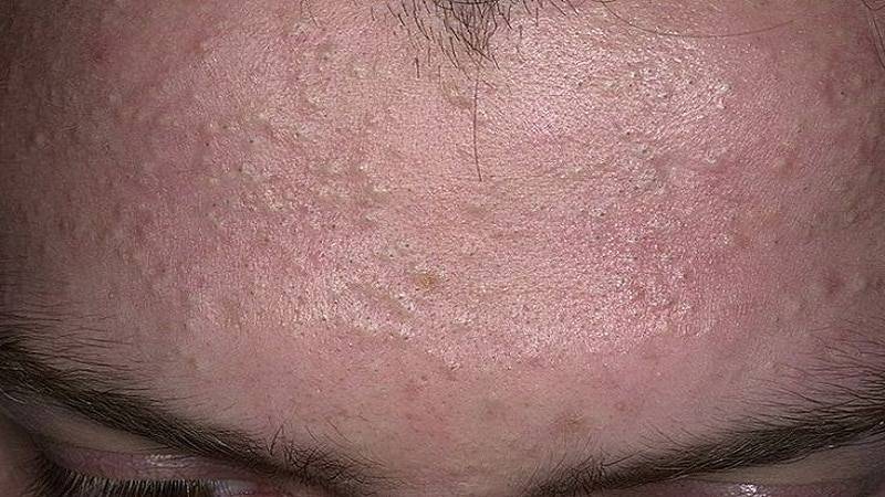 Сыпь на лице: возможные причины высыпаний у взрослых, места локализации, как бороться с кожной сыпью