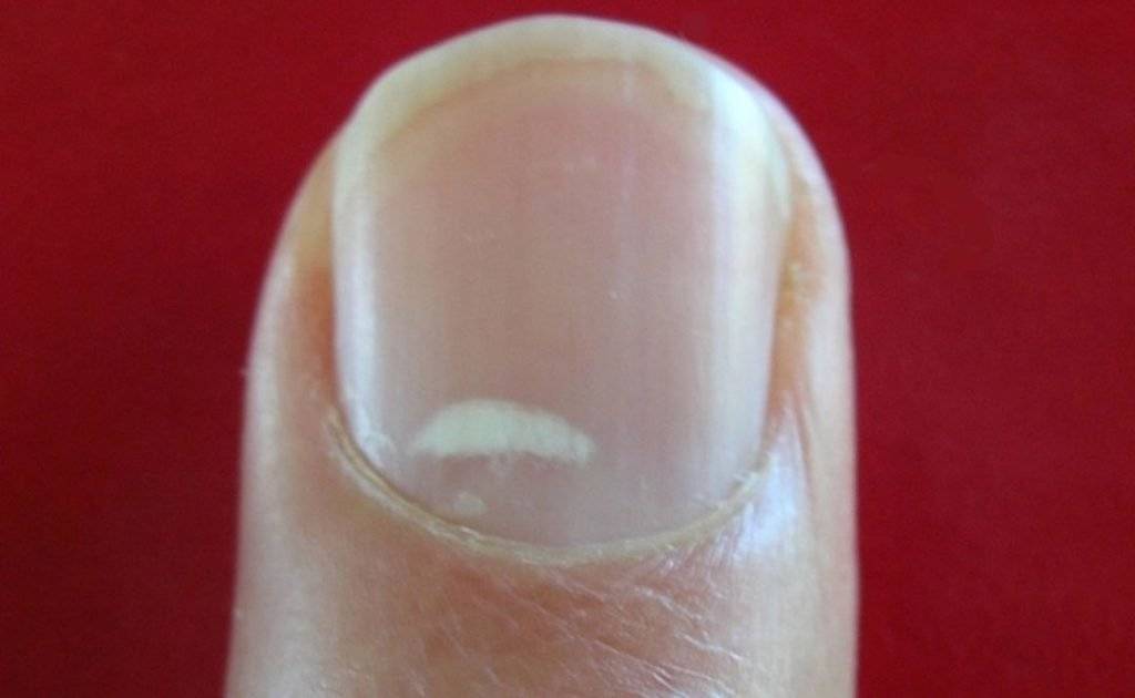 Какие вмятины могут появляться на ногтях, почему они возникают и как лечить?