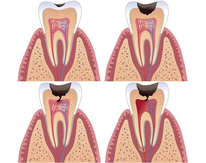 Пульпит зуба лечение народными средствами