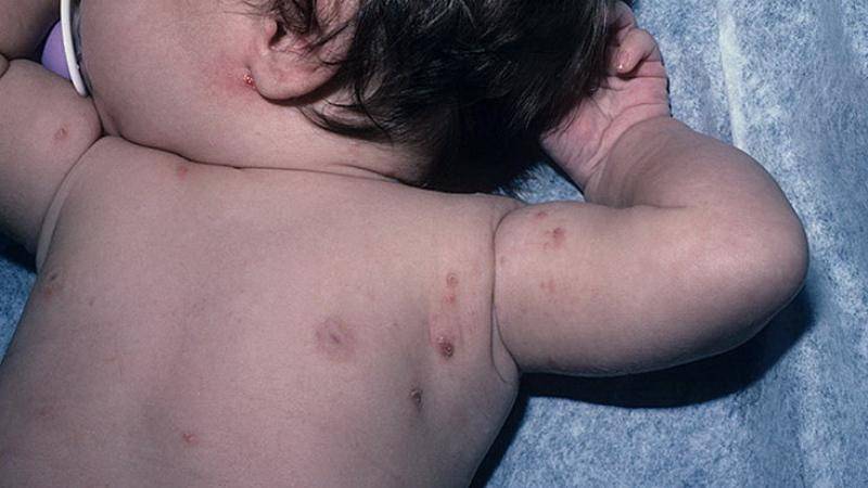 Розеола у детей: как выявить заболевание, его симптомы и фото