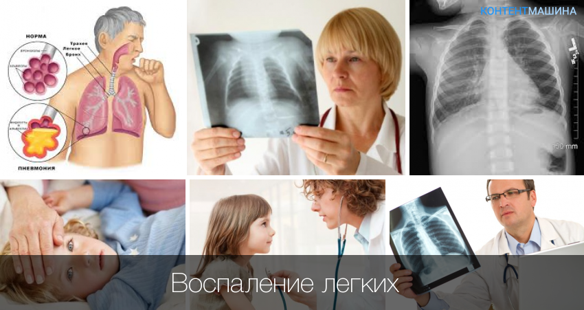 Двухсторонняя пневмония: симптомы и лечение | pnevmonya.ru