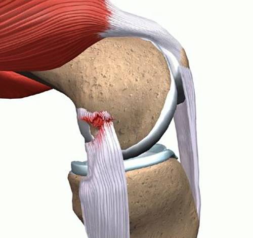 Лечение частичного разрыва мышц. Лигаментоз связок коленного сустава. Повреждение внутренней коллатеральной связки. Коллатеральная связка колена повреждение. Частичный разрыв коллатеральной связки.