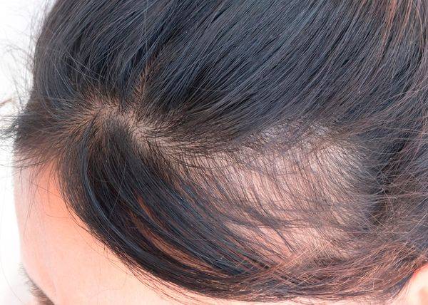 Могут ли выпадать волосы от проблем с кишечником?