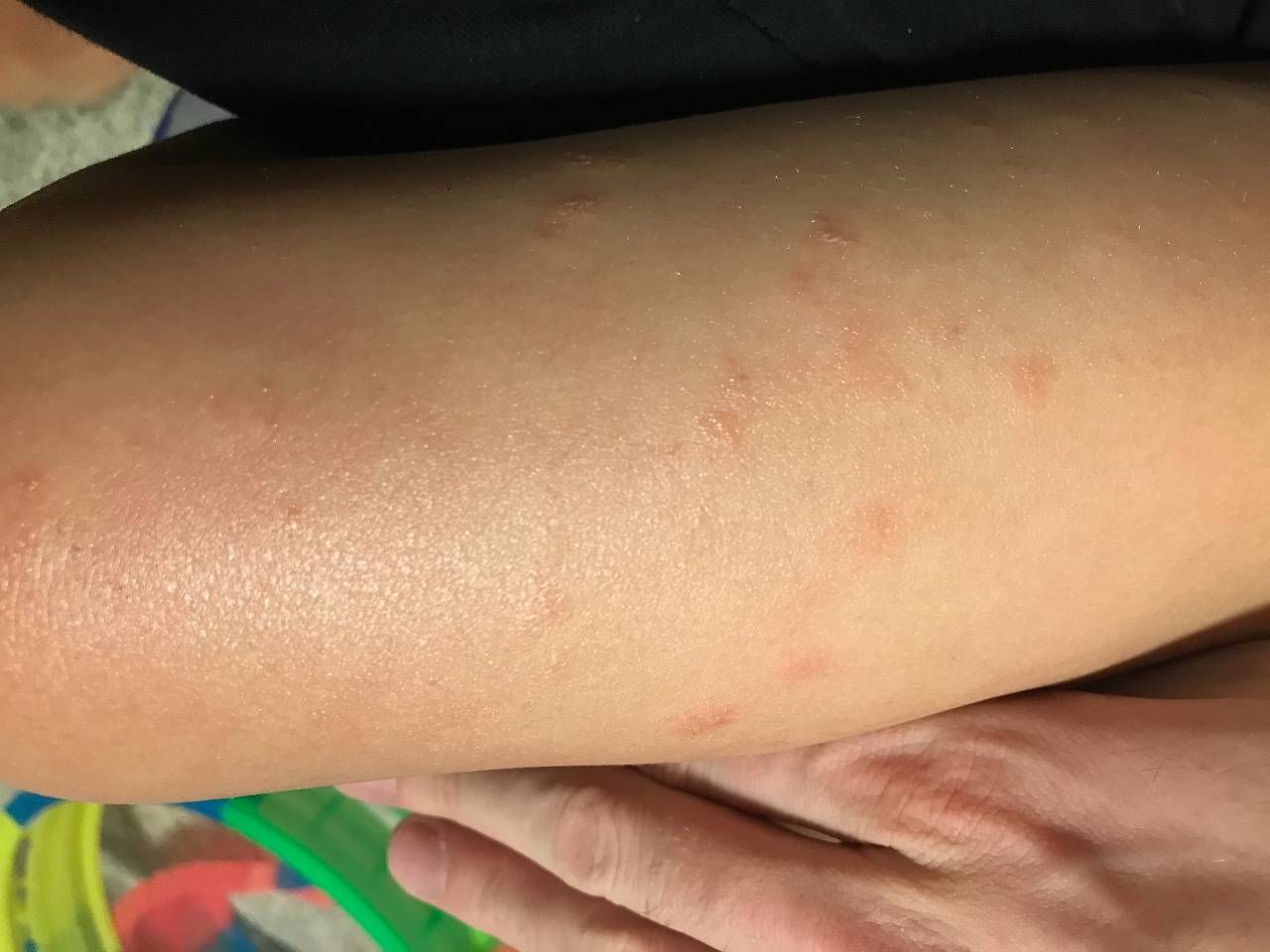 Аллергия без высыпаний на коже • аллергия и аллергические реакции