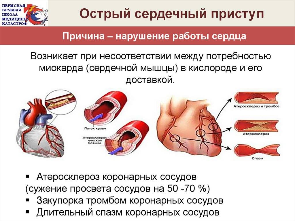 Заболевание сердца сопровождающееся сердечной недостаточностью. Синдром острой коронарной недостаточности. ПМП при острой сердечной недостаточности. Острой сердечной недостаточности презентация. Сердце с сердечной недостаточностью.