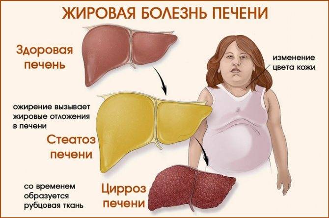 Как быстро и эффективно вылечить жировой гепатоз печени народными средствами