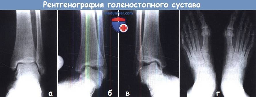 Рентген стопы: с нагрузкой, снимок ступни в двух проекциях