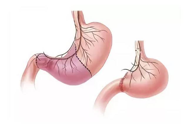 Удаление желудка: срок жизни после операции при раке, послеоперационное питание и диета, как жить когда удален орган
