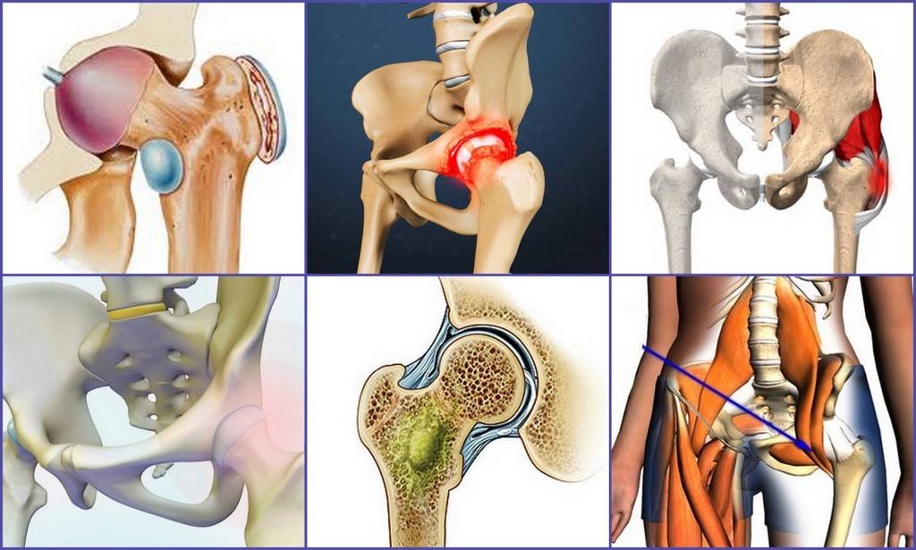 Народные методы лечения артрита тазобедренного сустава