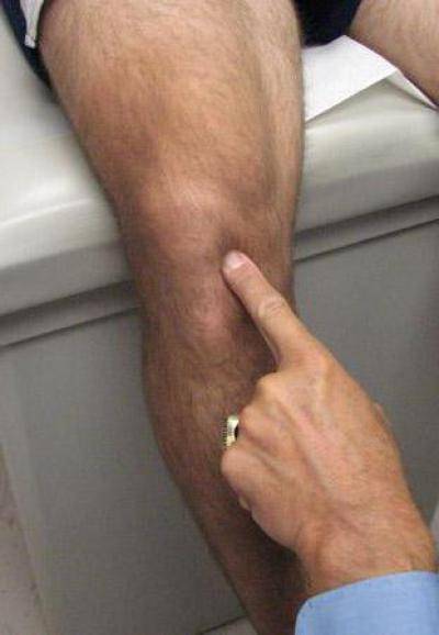 Боль в колене сбоку с внешней стороны: основные причины, лечение, сопутствующие симптомы