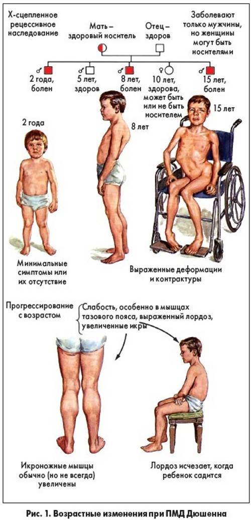 Миопатия дюшенна: лечение и симптомы синдрома миодистрофии, причины болезни, продолжительность жизни