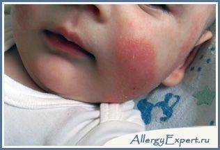 Аллергия на глютен у взрослых: причины, симптомы и что нельзя