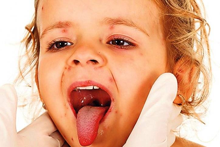 Герпесная ангина у детей и взрослых: фото, симптомы и лечение | pro-herpes.ru