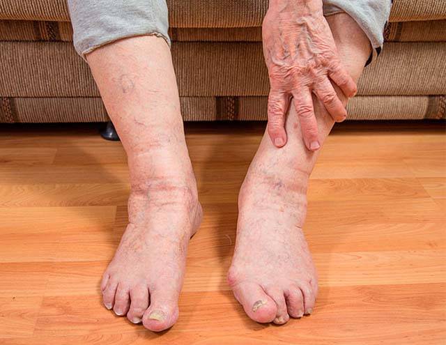 Судороги ног ночью у пожилых причины и лечение