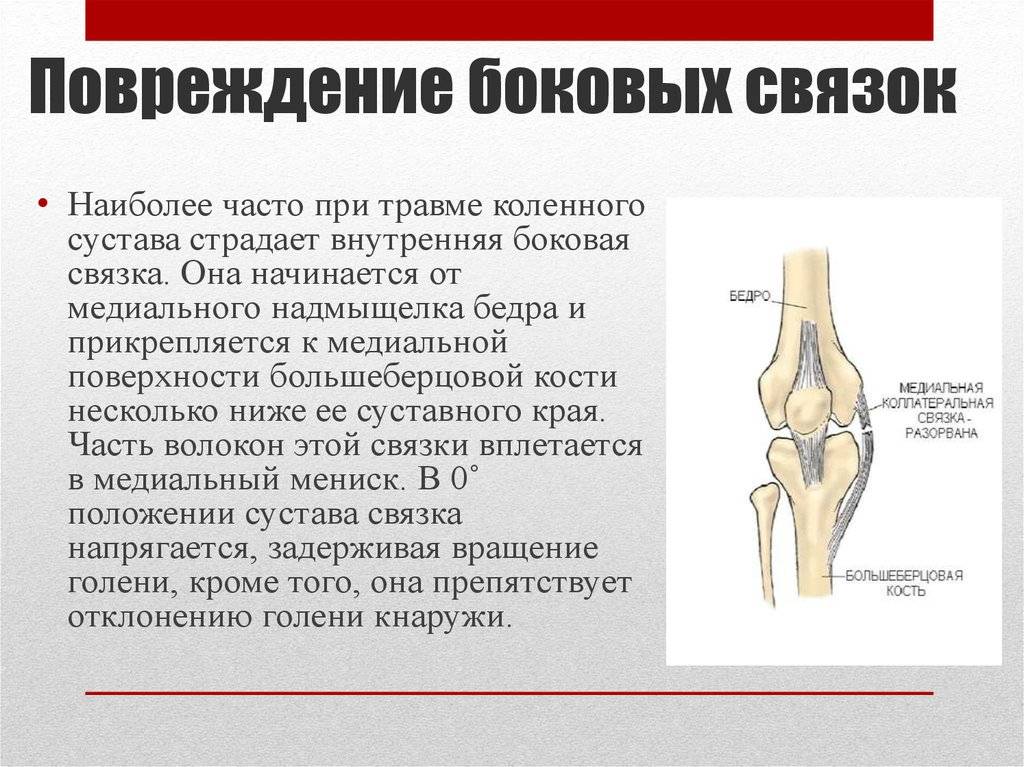Повреждение коленной связки симптомы. Повреждения внутренней боковой связки колена. Внутренняя боковая связка колена разрыв лечение. Травмы связок коленного сустава. Повреждение боковых связок коленного сустава.