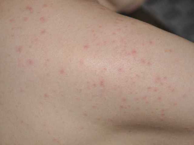 Аллергия на коже - 140 фото и видео высыпаний и советы по лечению