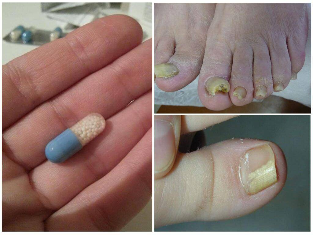 Обзор лекарств от грибка ногтей на ногах — список самых эффективных препаратов