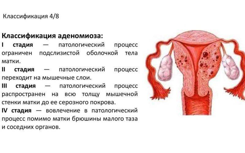 Симптомы эндометриоза матки у женщин при климаксе