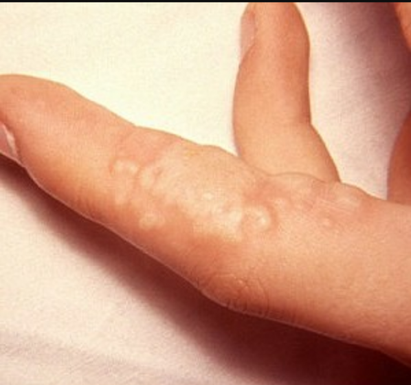 Водянистые пузырьки (прыщи) на пальцах рук. причины, симптомы, лечение