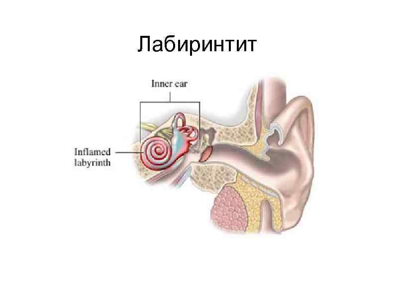 Болезнь внутреннего уха. Воспаление среднего уха (лабиринтит);. Воспаление внутреннего уха лабиринтит. Воспаление среднего уха лабиринтит симптомы.