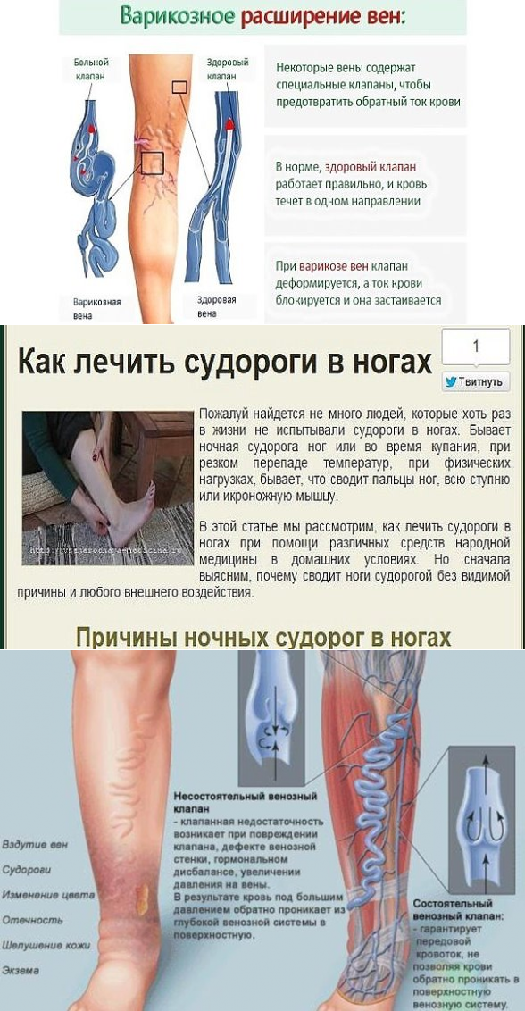 Судороги в ногах (икрах) ночью – причина и лечение, что делать при судорогах