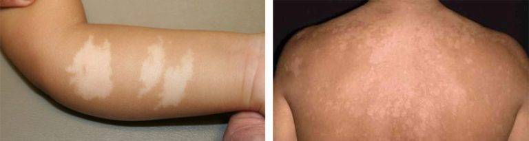 Коричневые пятна на теле: фото, причины, лечение | заболевания кожи