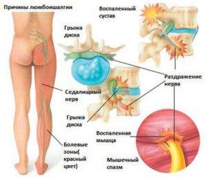 Боль в спине отдающая в ногу лечение препараты