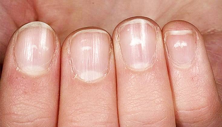 Белые пятна на ногтях пальцев рук: причина у женщин и мужчин, приметы, что означает, как лечить, последствия