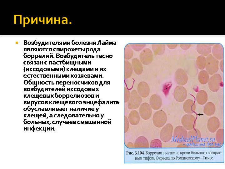 Болезнь лайма (клещевой боррелиоз): симптомы, лечение, фото