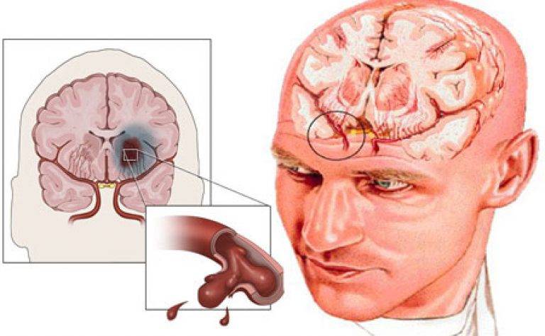 Как лечить энцефалопатию головного мозга