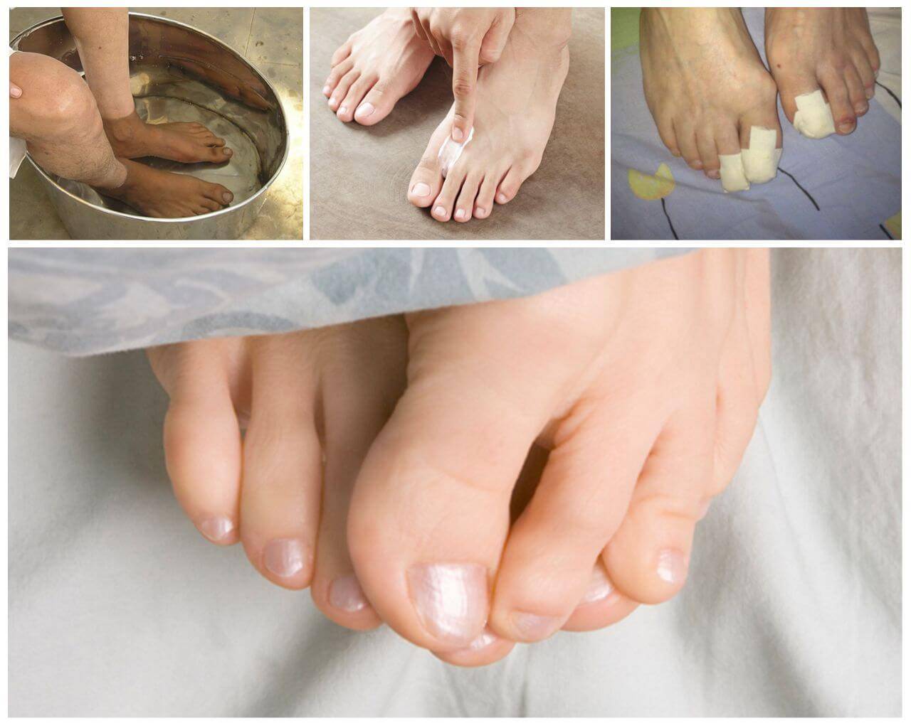 Лечение ногтевого грибка на ногах. Народные ногти на ногах.