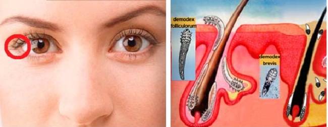 Мази от демодекса, гарантирующие полное истребление паразитарных клещей, атакующих веки глаз