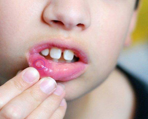 Кандидозный стоматит у взрослых во рту: симптомы, лечение, фото
