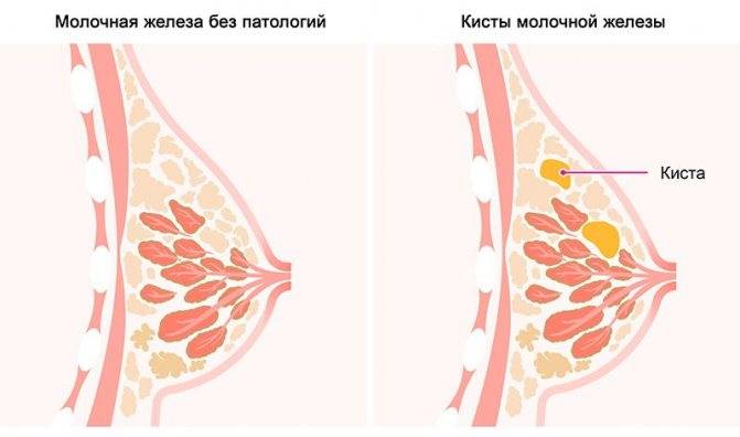 Почему перед месячными грудь набухает и сильно болит — ответ гинеколога