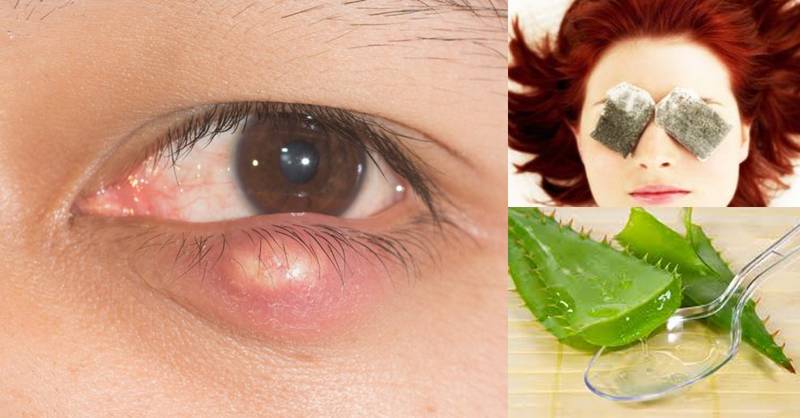 Чем лечить покраснение глаз. народные средства снятия воспаления слизистой оболочки глаза