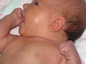 Потничка на лице у новорожденных и грудничков (35 фото): как выглядит и чем лечить, лечение бепантеном