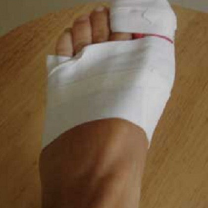 Сколько срастается перелом пальца на ноге
