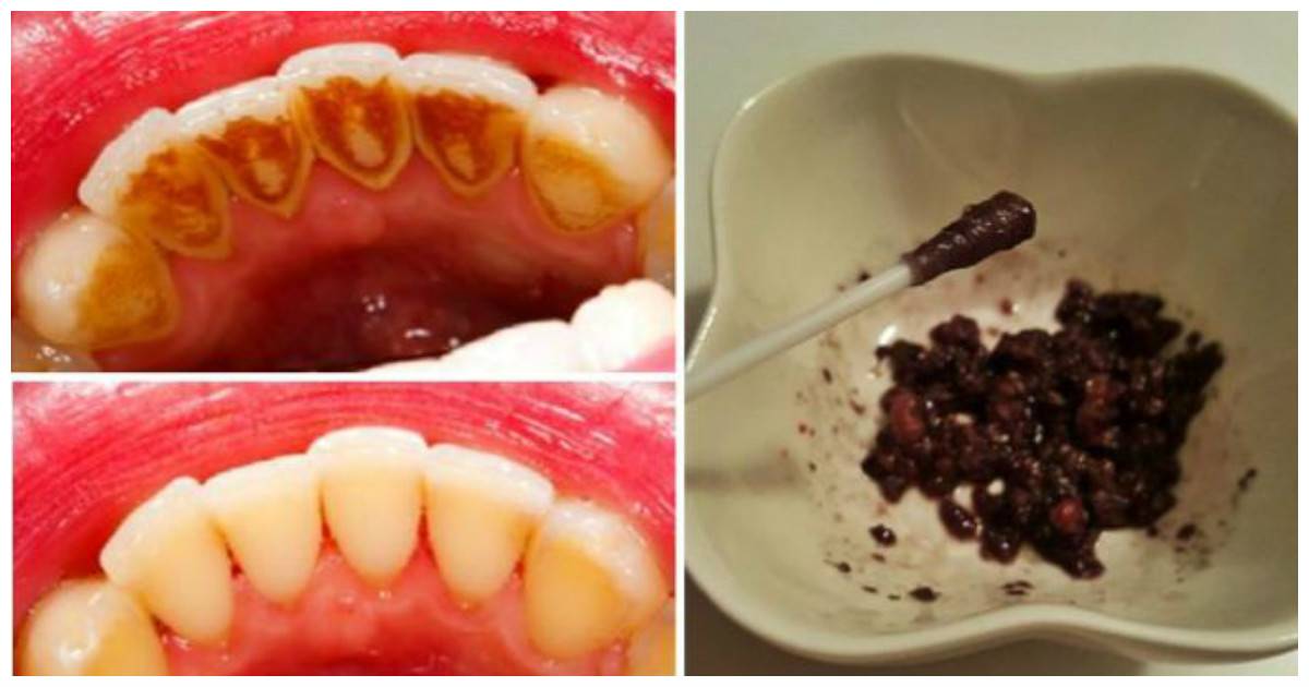 Причины неприятного запаха из полости рта после удаления зуба
